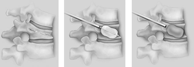Kyphoplasty image