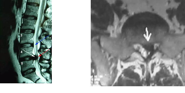 MRI image lumbar spine showing disc herniation