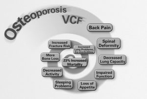 Compression fracture image