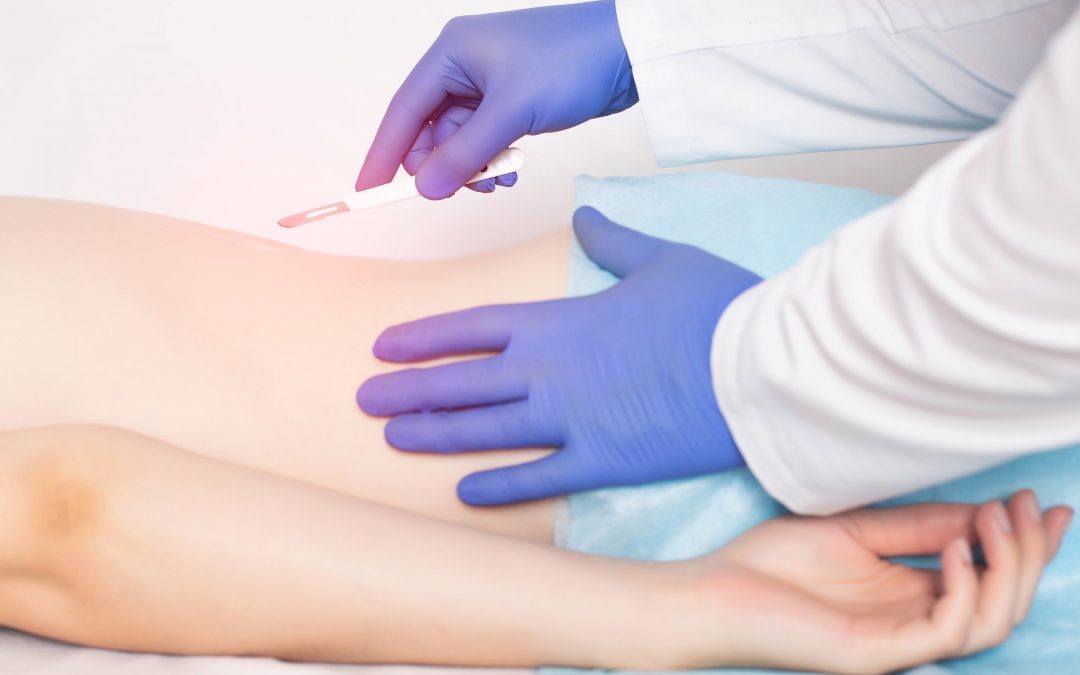 Gloved surgeon's hand holding a scalpel over a patient's lower back at the site of a planned incision.